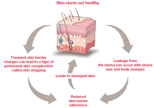 vicious_cycle-peristomal-skin-health-ostomy-illustration